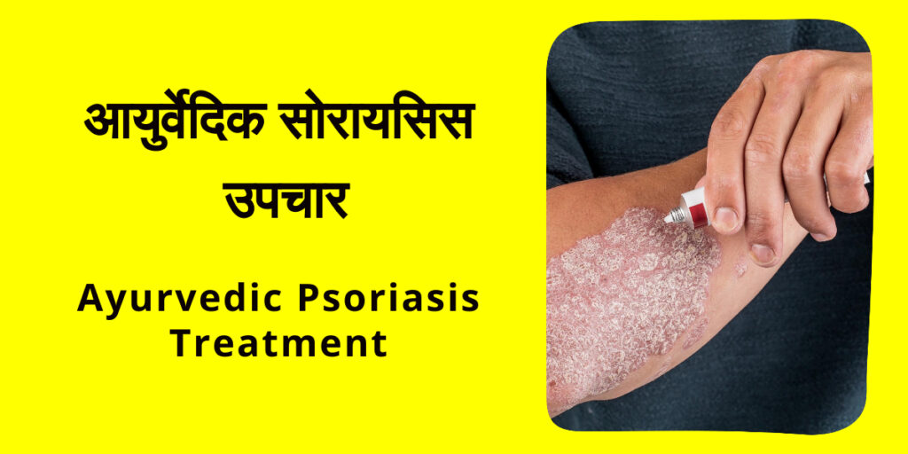 Ayurvedic Psoriasis Treatment in Hindi