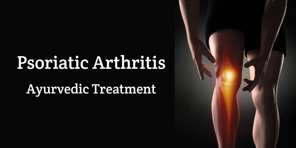 Psoriatic Arthritis Treatment in Ayurveda