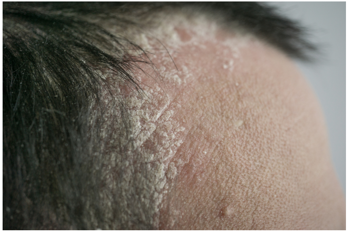 Scalp Psoriasis Treatment - Ayurvedic Psoriasis Treatment