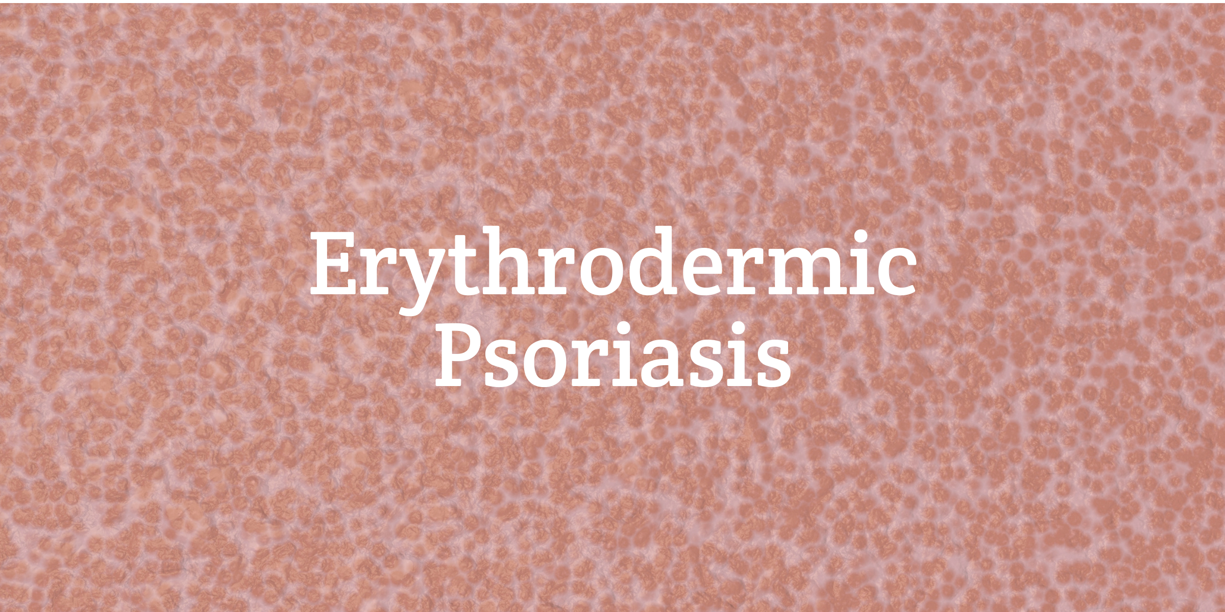 Erythrodermic Psoriasis Treatment