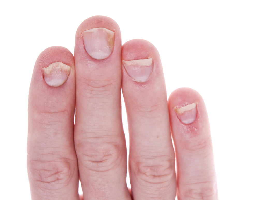 Why Nail Psoriasis takes Time to Heal?