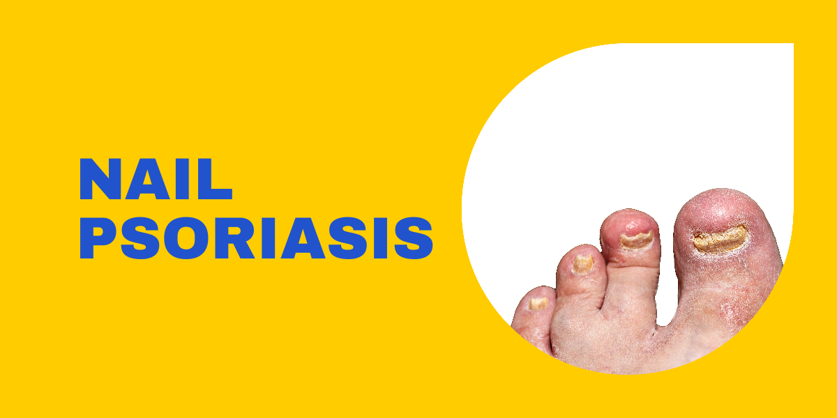 Nail psoriasis treatment
