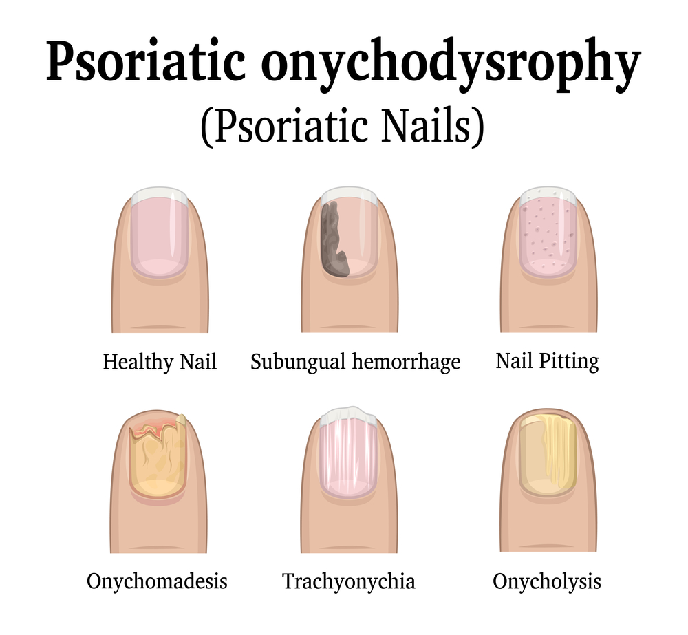 Nail psoriasis - Mayo Clinic