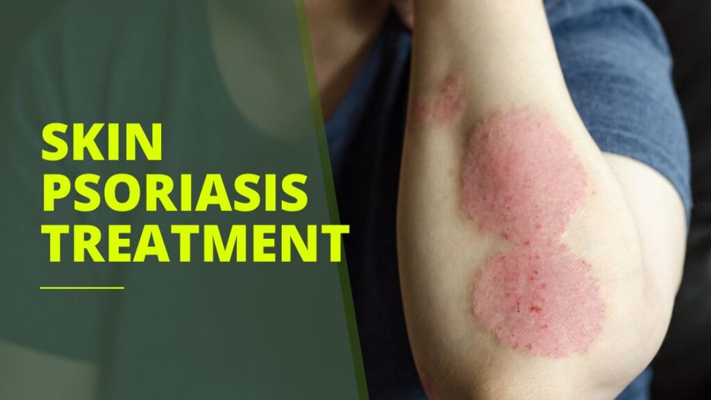 skin psoriasis treatment